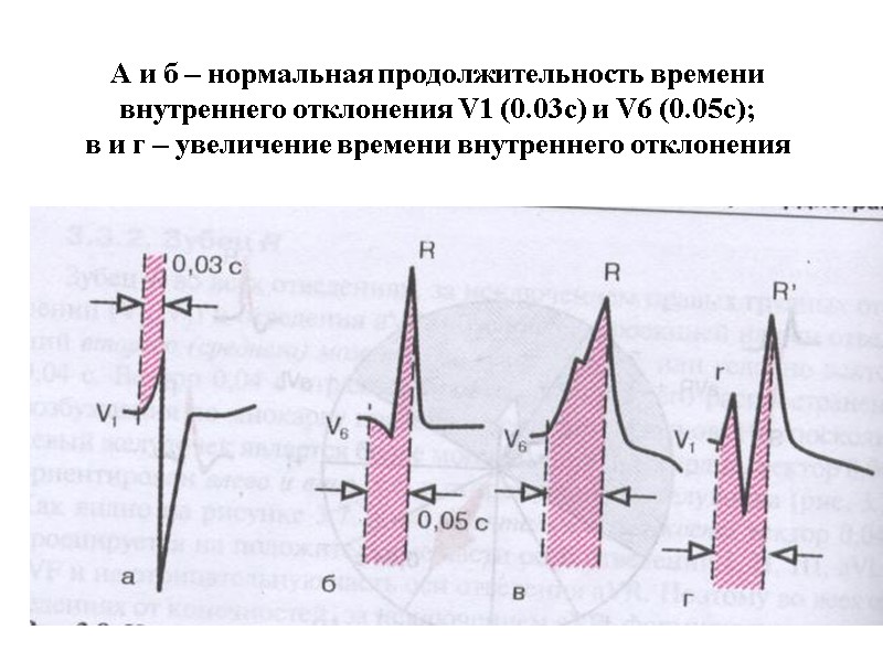 А и б – нормальная продолжительность времени внутреннего отклонения V1 (0.03с) и V6 (0.05с);